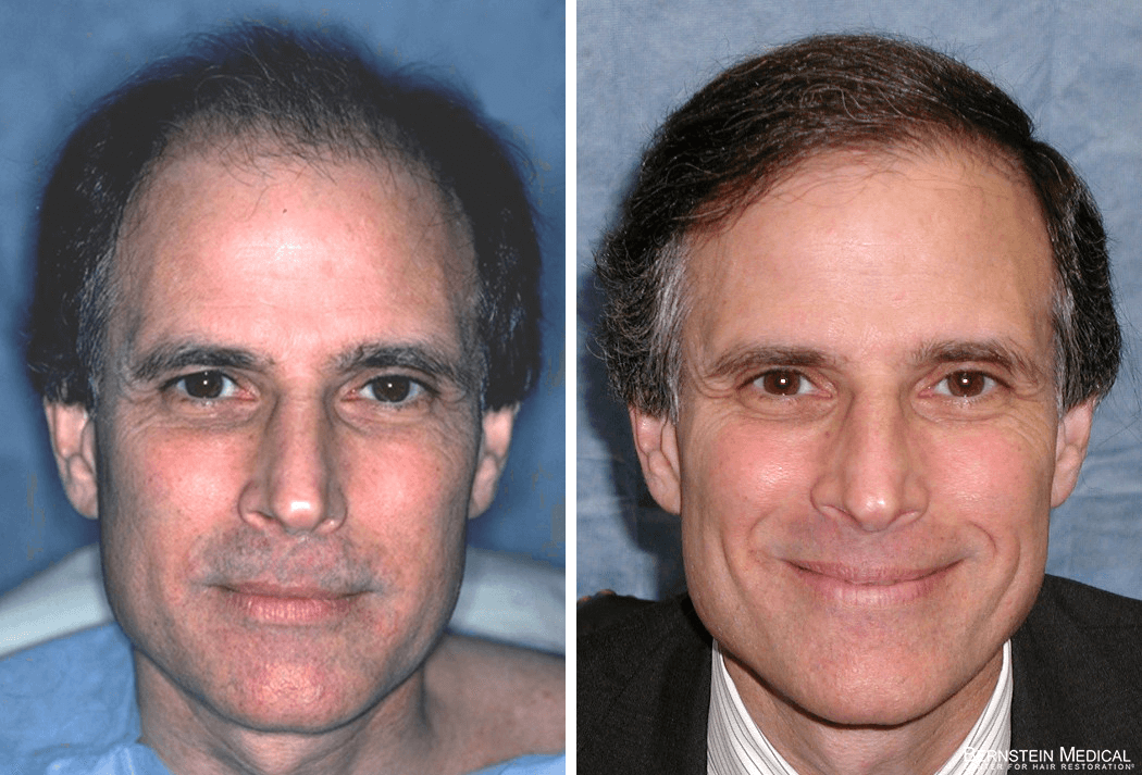 Bernstein Medical - Patient EUQ Before and After Hair Transplant Photo 