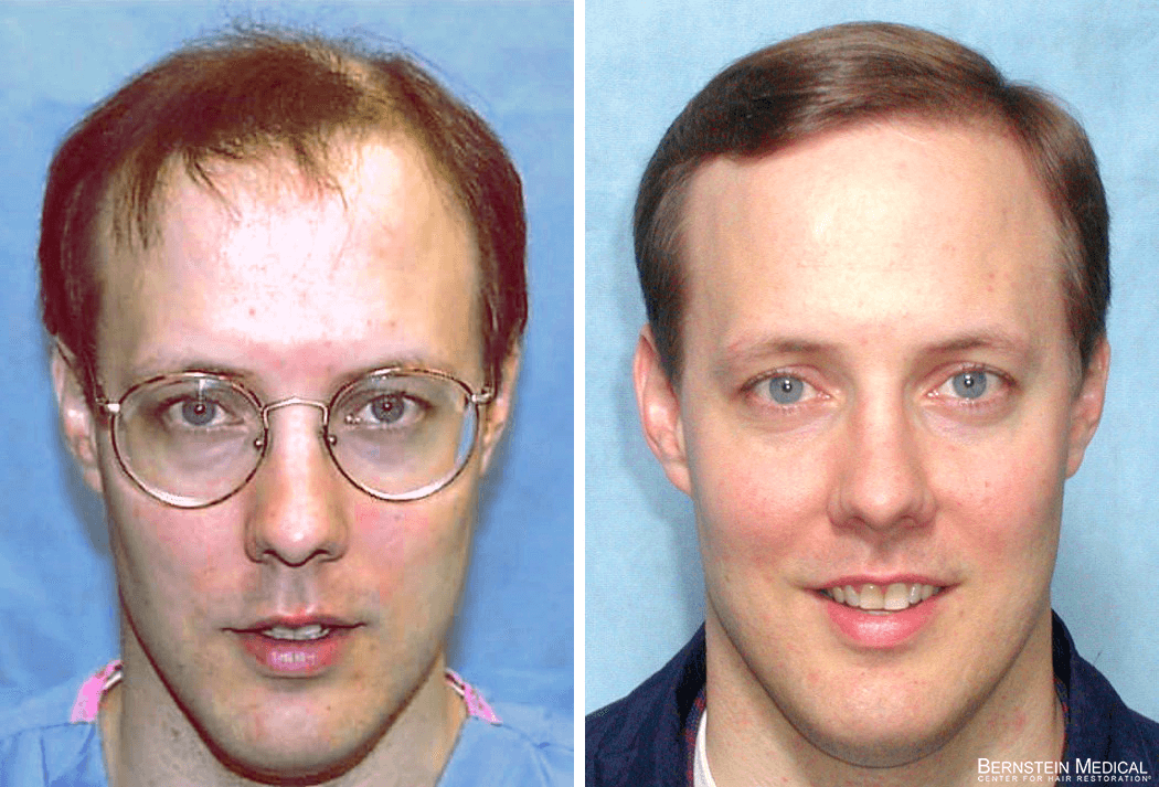 Bernstein Medical - Patient EVI Before and After Hair Transplant Photo 