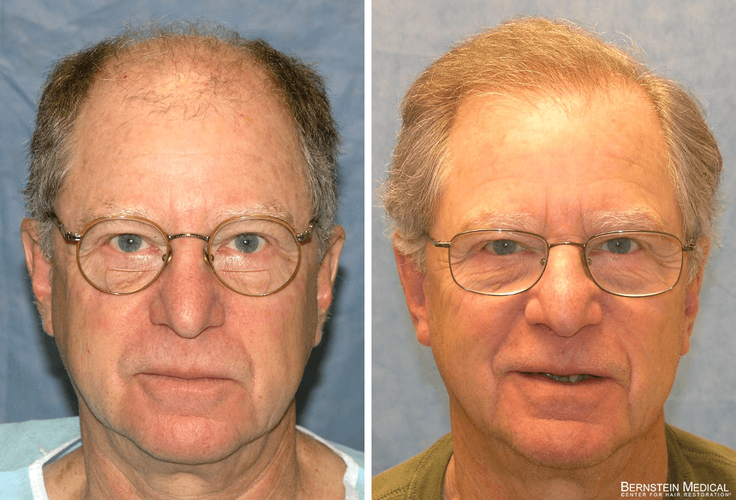 Bernstein Medical - Patient FBQ Before and After Hair Transplant Photo 