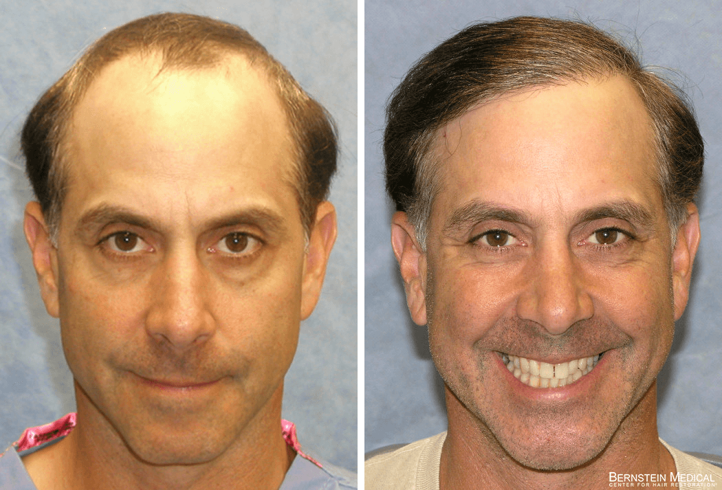 Bernstein Medical - Patient FDB Before and After Hair Transplant Photo 