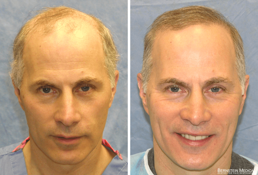 Bernstein Medical - Patient FGQ Before and After Hair Transplant Photo 