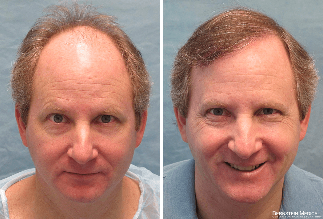Bernstein Medical - Patient FVR Before and After Hair Transplant Photo 