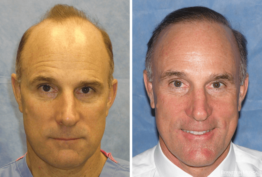 Bernstein Medical - Patient FWB Before and After Hair Transplant Photo 