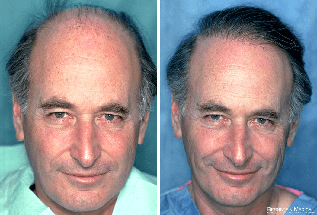 Bernstein Medical - Patient FXZ Before and After Hair Transplant Photo 
