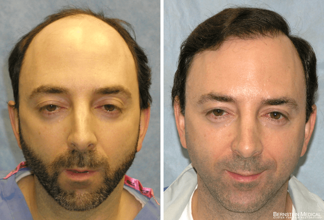 Bernstein Medical - Patient FYF Before and After Hair Transplant Photo 