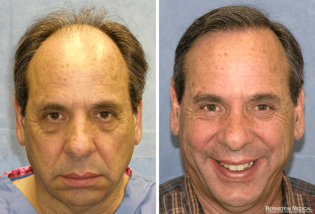 Bernstein Medical - Patient FZI Before and After Hair Transplant Photo 
