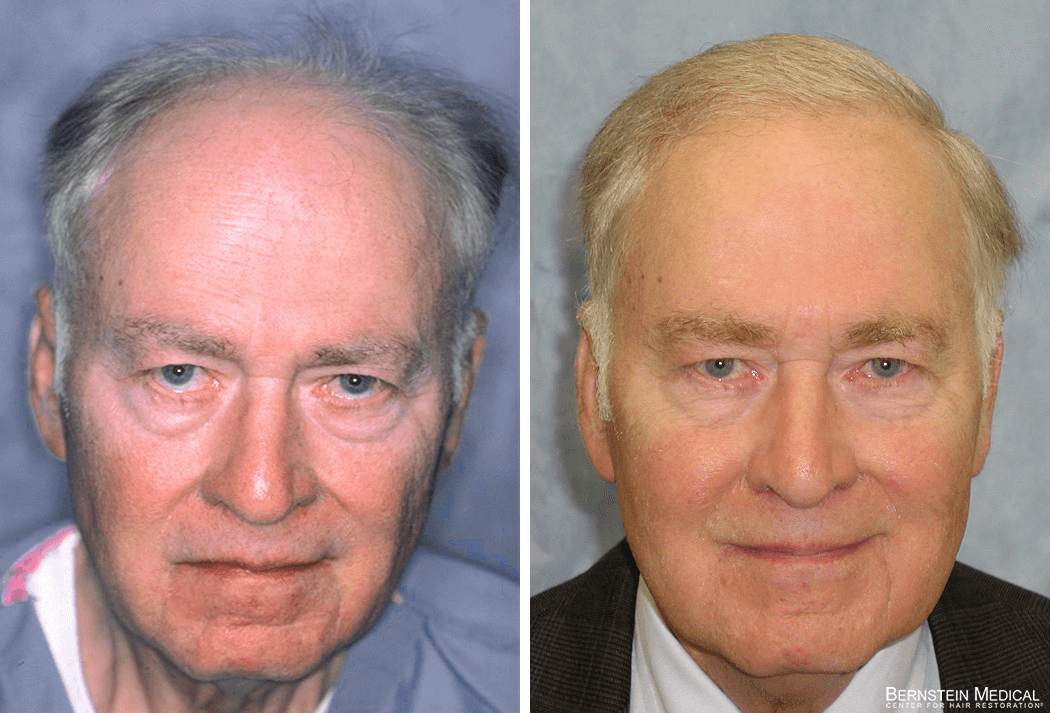 Bernstein Medical - Patient GAQ Before and After Hair Transplant Photo 