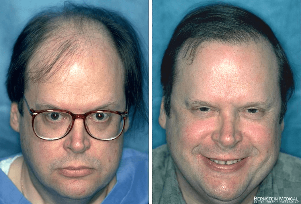 Bernstein Medical - Patient GBF Before and After Hair Transplant Photo 