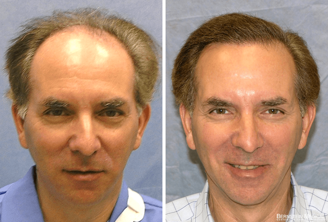 Bernstein Medical - Patient GDL Before and After Hair Transplant Photo 