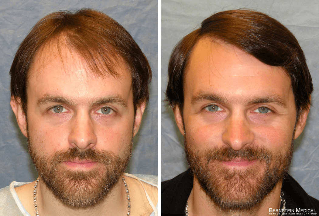 Bernstein Medical - Patient GEL Before and After Hair Transplant Photo 