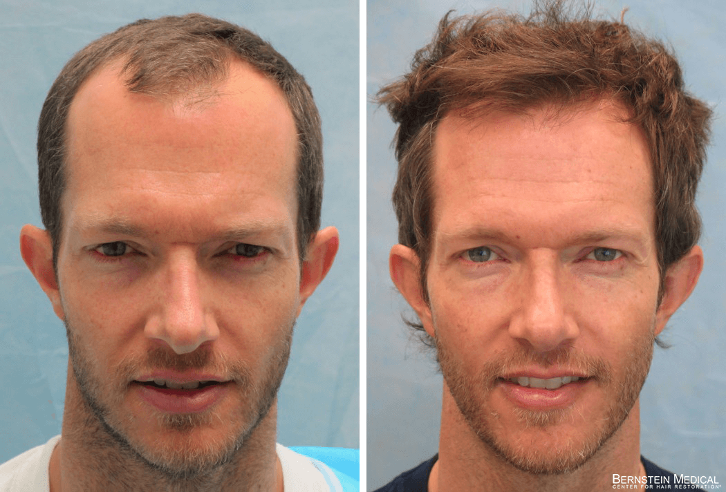 Hair Transplant NYC | Hair Restoration New York