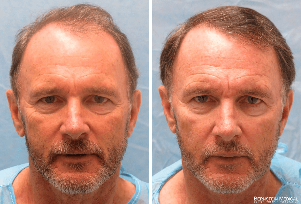 Bernstein Medical - Patient GMZ Before and After Hair Transplant Photo 