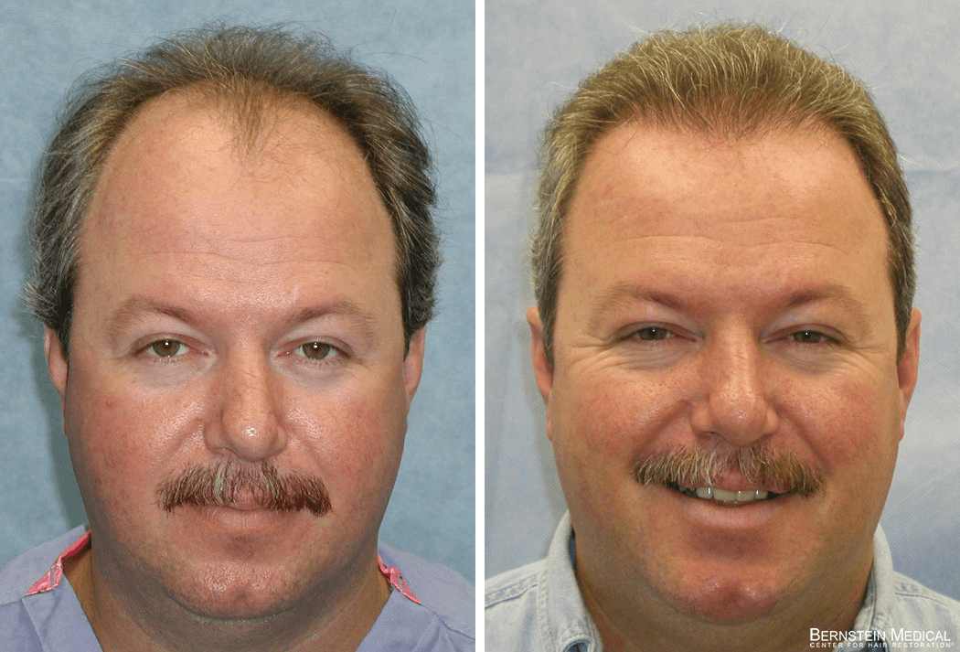 Bernstein Medical - Patient HND Before and After Hair Transplant Photo 