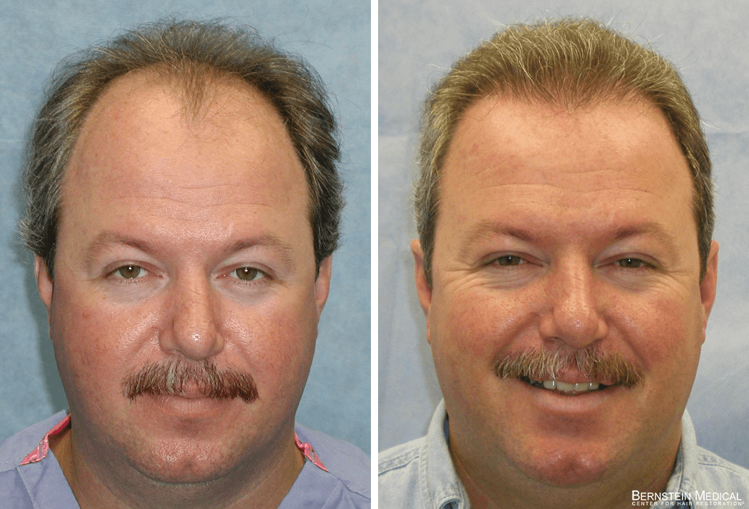 Bernstein Medical - Patient HND Before and After Hair Transplant Photo