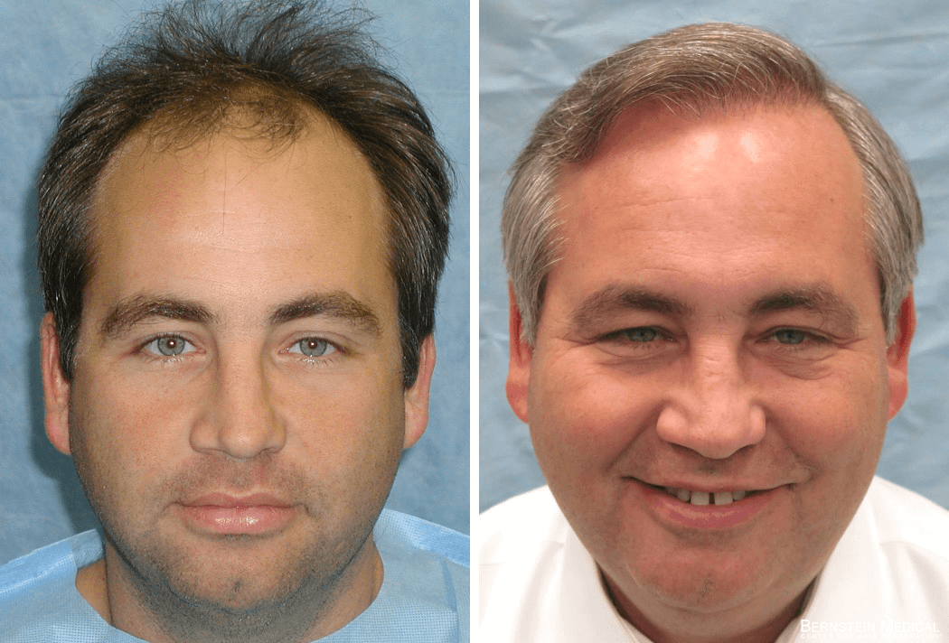 Bernstein Medical - Patient HYC Before and After Hair Transplant Photo 