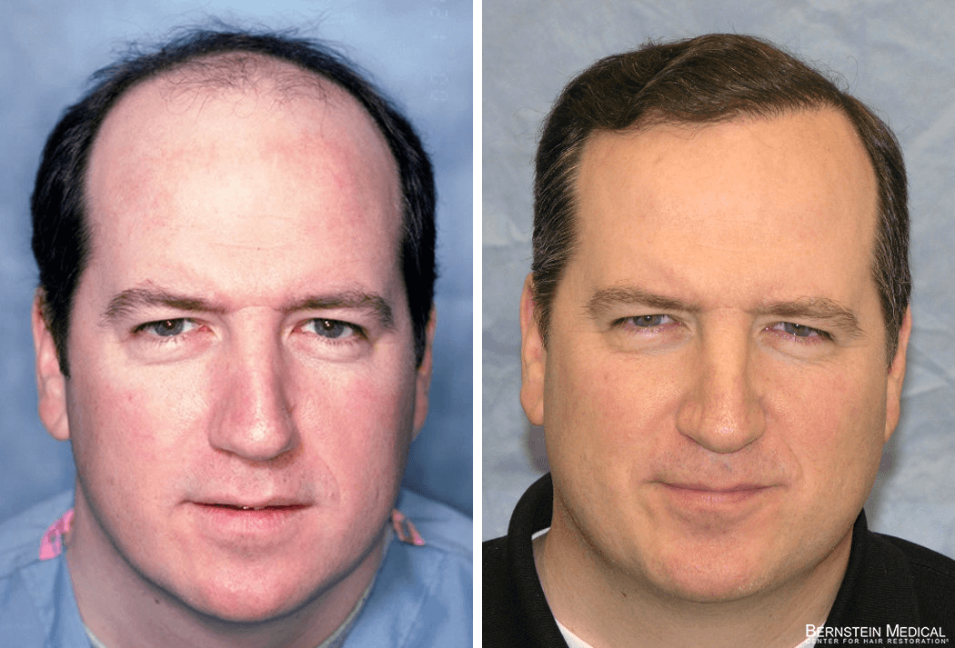 Bernstein Medical - Patient IHR Before and After Hair Transplant Photo 