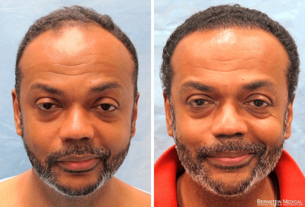 Bernstein Medical Hair Restoration Before and After - Patient IJC
