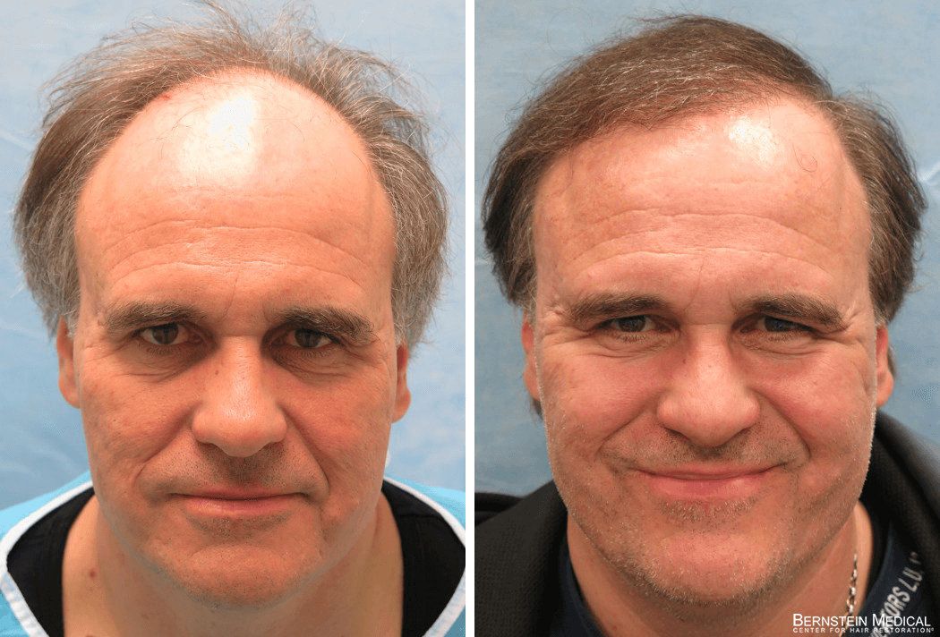 Bernstein Medical - Patient IOI Before and After Hair Transplant Photo 