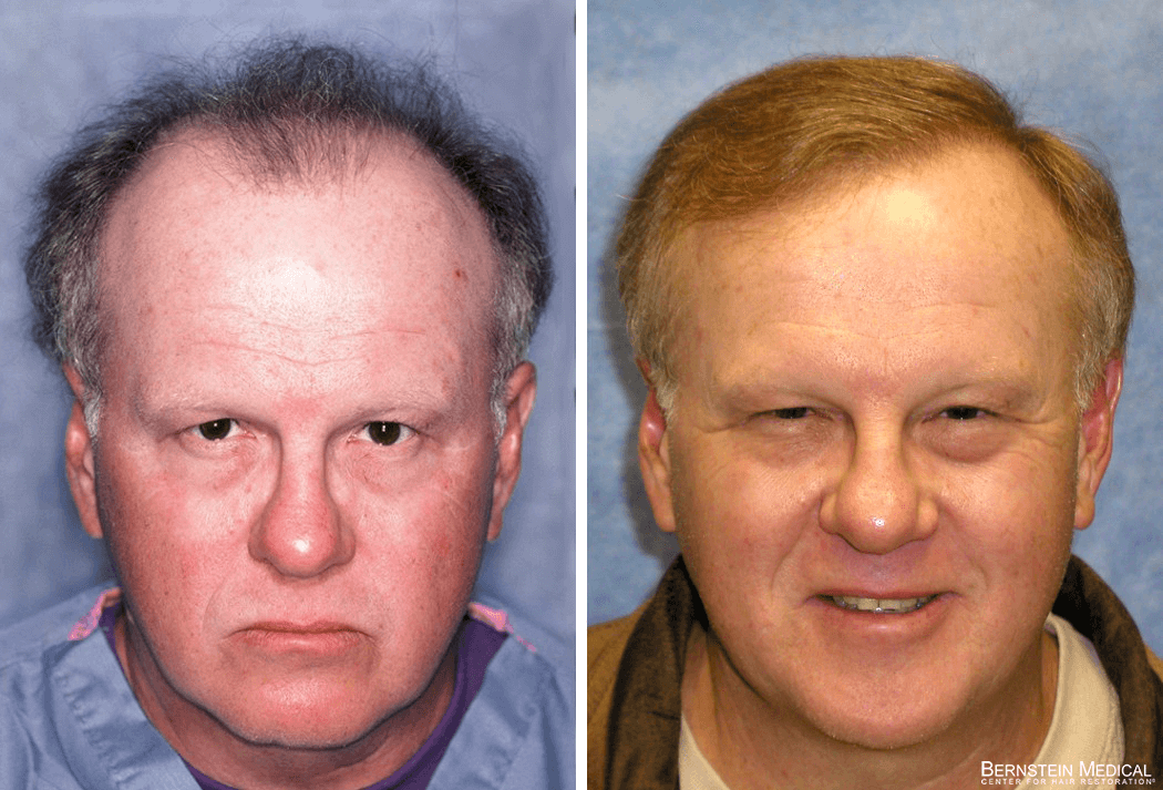 Bernstein Medical - Patient JCQ Before and After Hair Transplant Photo 