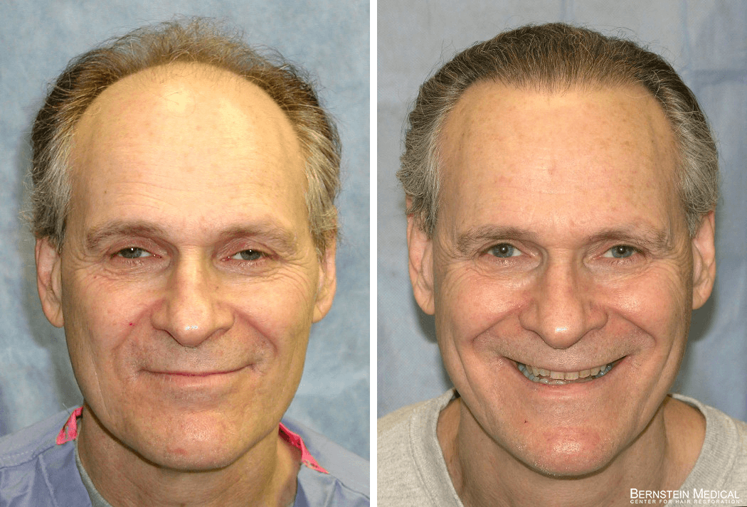 Bernstein Medical - Patient JDL Before and After Hair Transplant Photo 