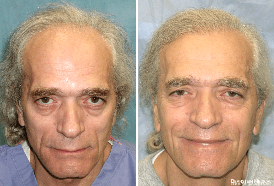 Bernstein Medical - Patient JDQ Before and After Hair Transplant Photo 