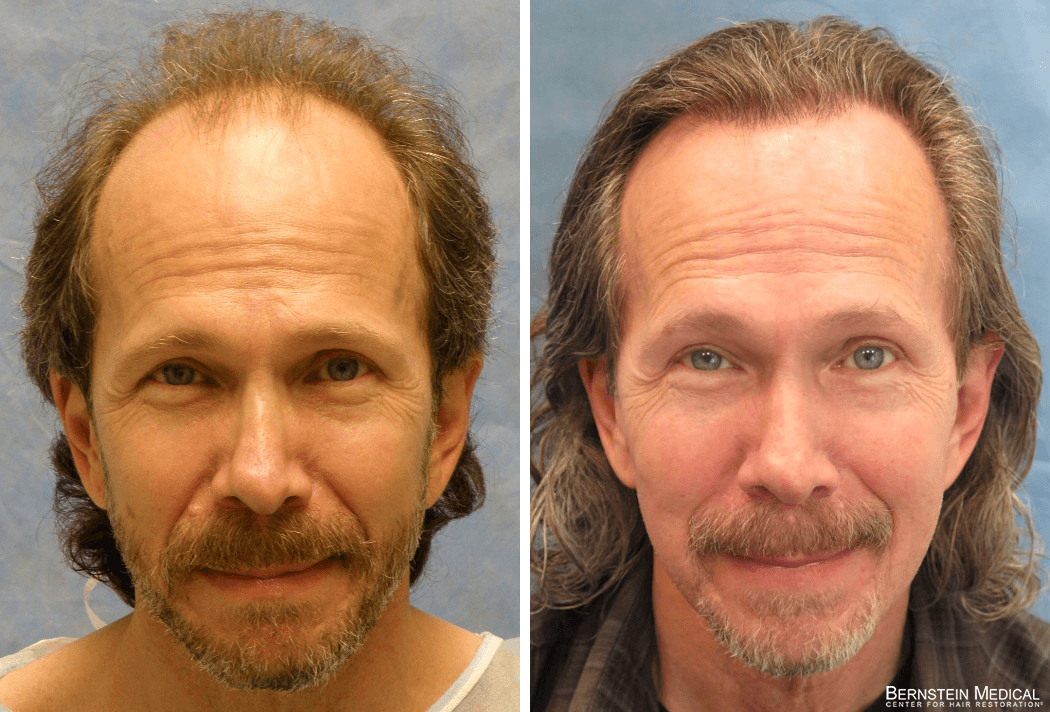Bernstein Medical - Patient JKJ Before and After Hair Transplant Photo 