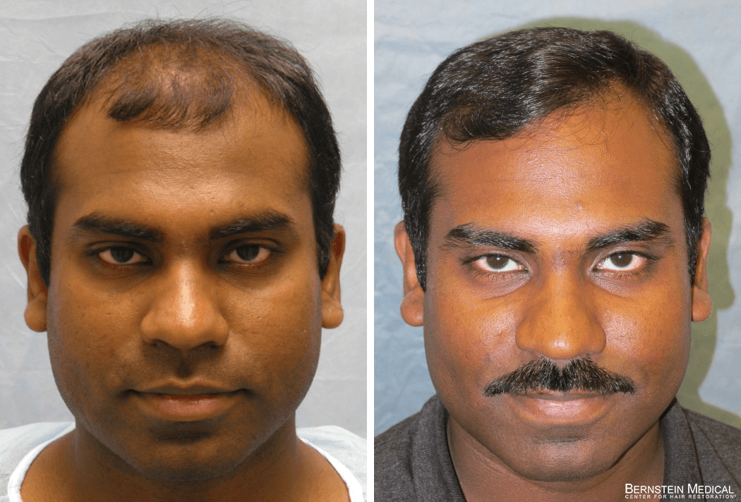 Bernstein Medical - Patient JVI Before and After Hair Transplant Photo 