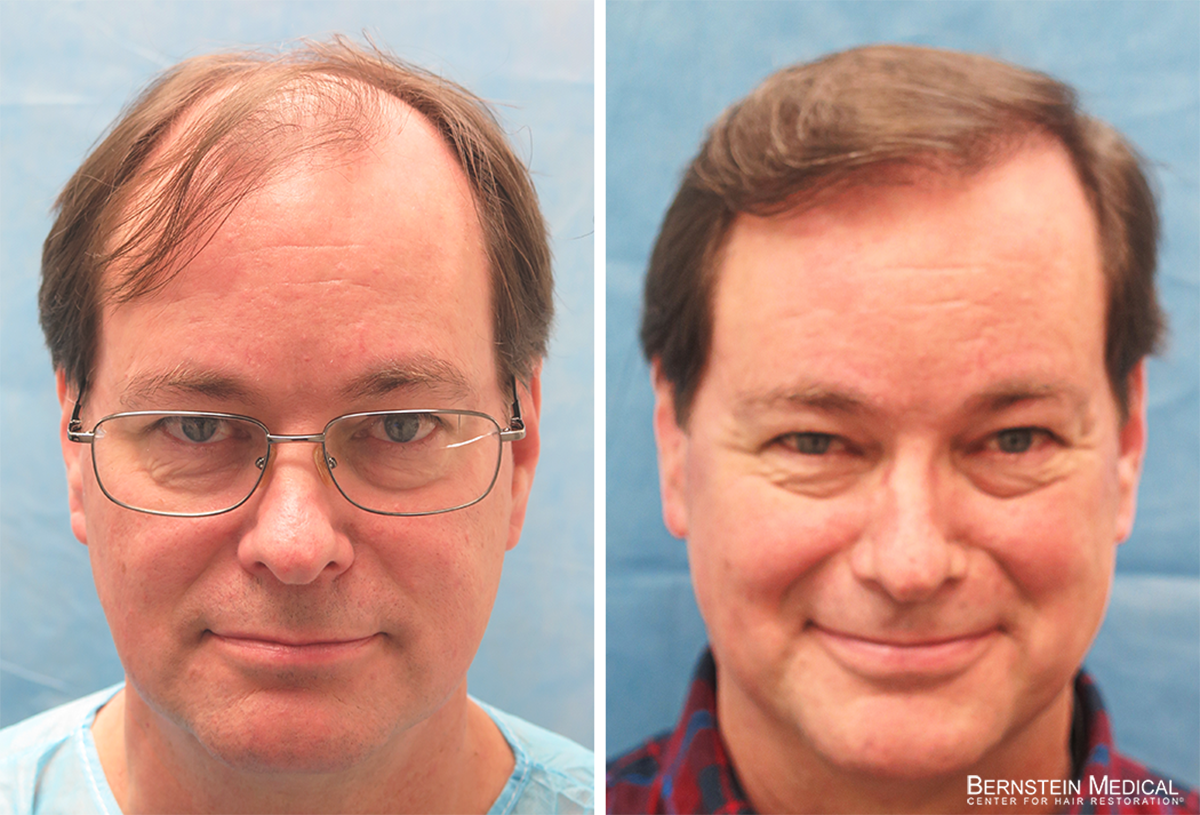 Bernstein Medical - Patient JYC Before and After Hair Transplant Photo