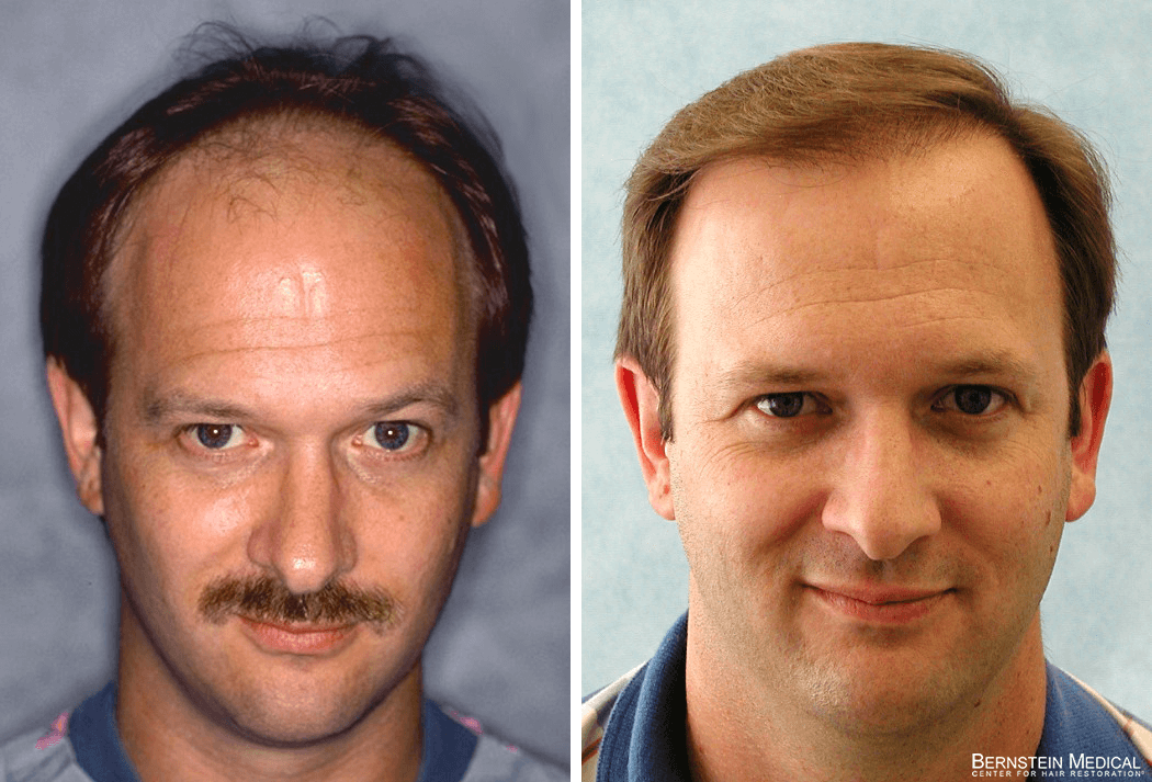 Bernstein Medical - Patient KEI Before and After Hair Transplant Photo 