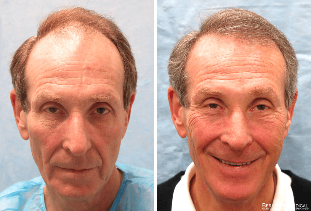 Bernstein Medical - Patient KHI Before and After Hair Transplant Photo 