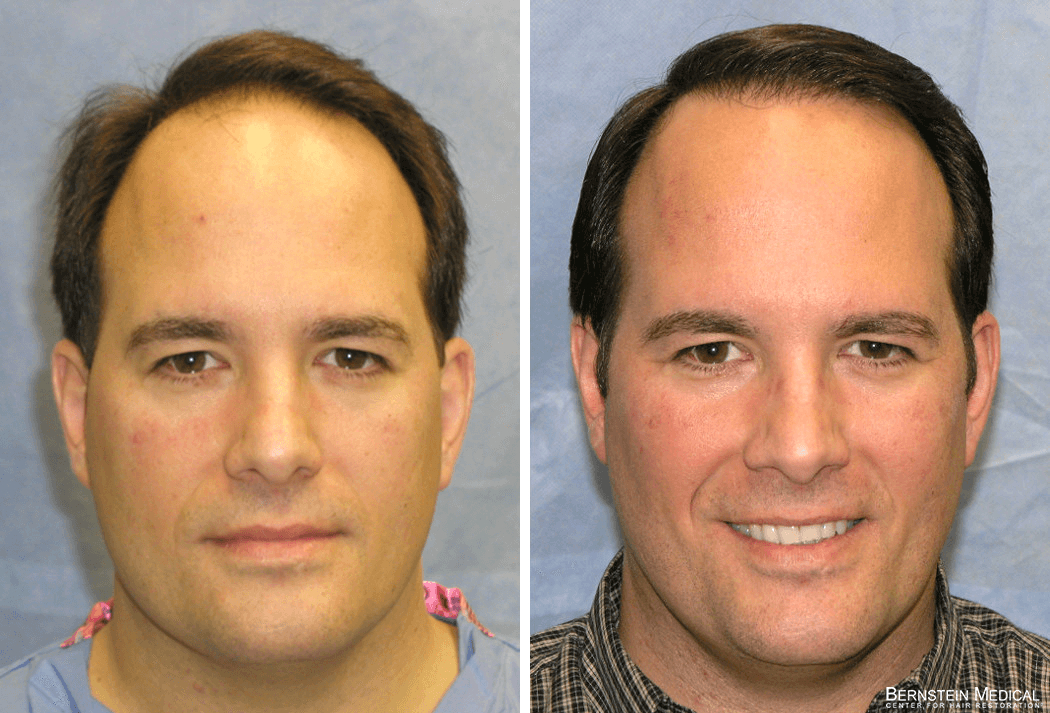 Bernstein Medical - Patient KMR Before and After Hair Transplant Photo 