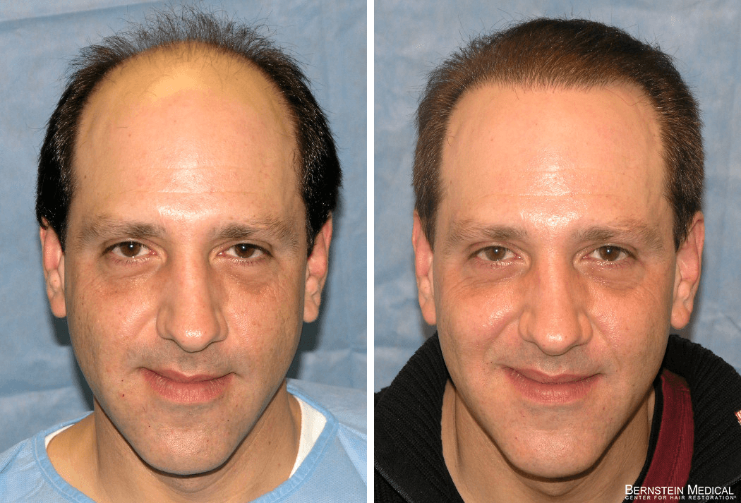 Bernstein Medical - Patient LAB Before and After Hair Transplant Photo 