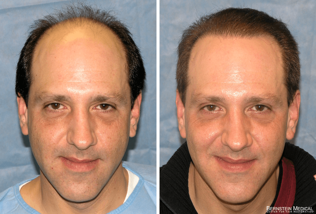 Bernstein Medical - Patient LAB Before and After Hair Transplant Photo