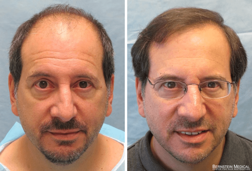 Bernstein Medical - Patient LCF Before and After Hair Transplant Photo 