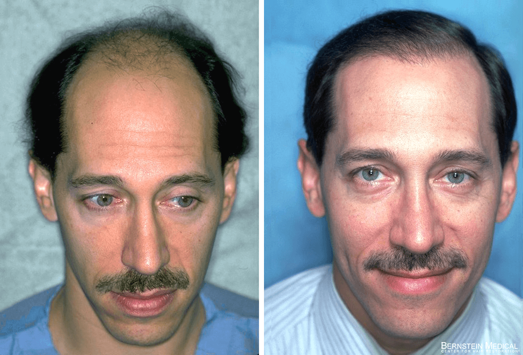 Bernstein Medical - Patient LFL Before and After Hair Transplant Photo 