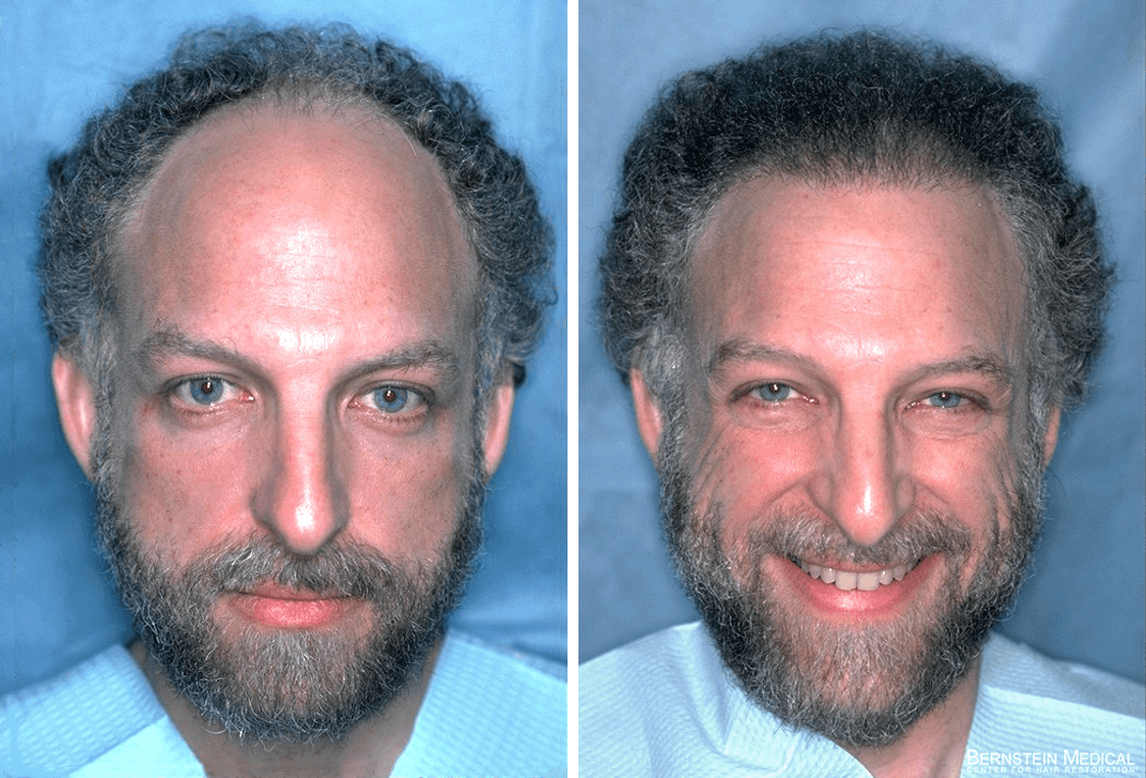 Bernstein Medical - Patient LGK Before and After Hair Transplant Photo 