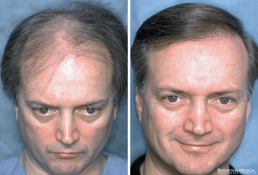 Bernstein Medical - Patient LIF Before and After Hair Transplant Photo
