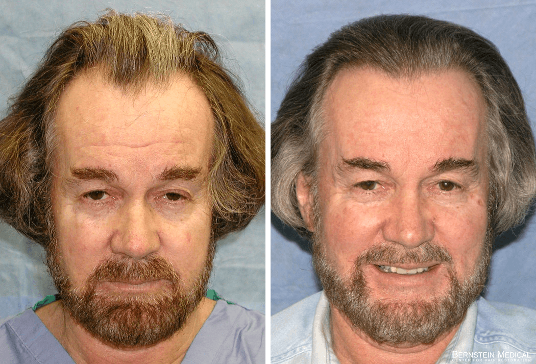 Bernstein Medical - Patient LTI Before and After Hair Transplant Photo 