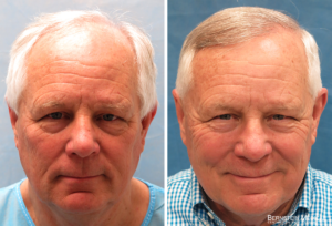 Before After Hair Transplant - Patient LWC