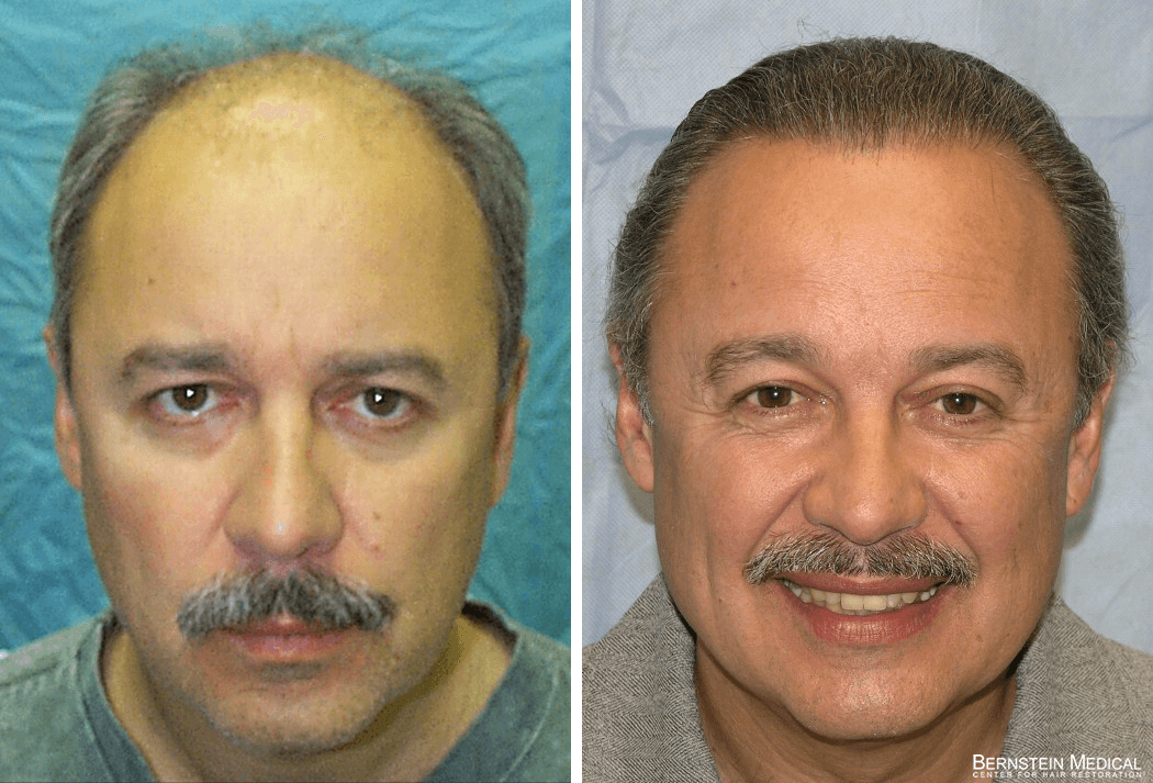 Bernstein Medical - Patient MJL Before and After Hair Transplant Photo 