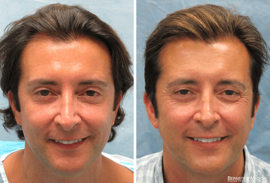 Bernstein Medical - Patient ODQ Before and After Hair Transplant Photo 