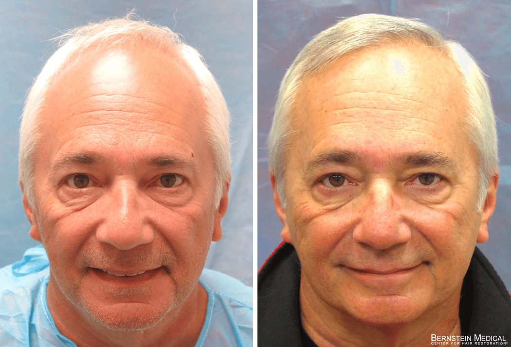 Bernstein Medical - Patient OFO Before and After Hair Transplant Photo 