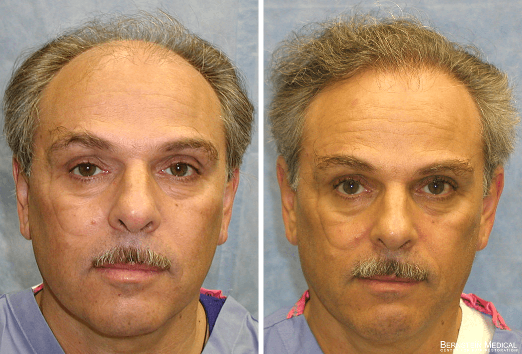 Bernstein Medical - Patient OKZ Before and After Hair Transplant Photo 
