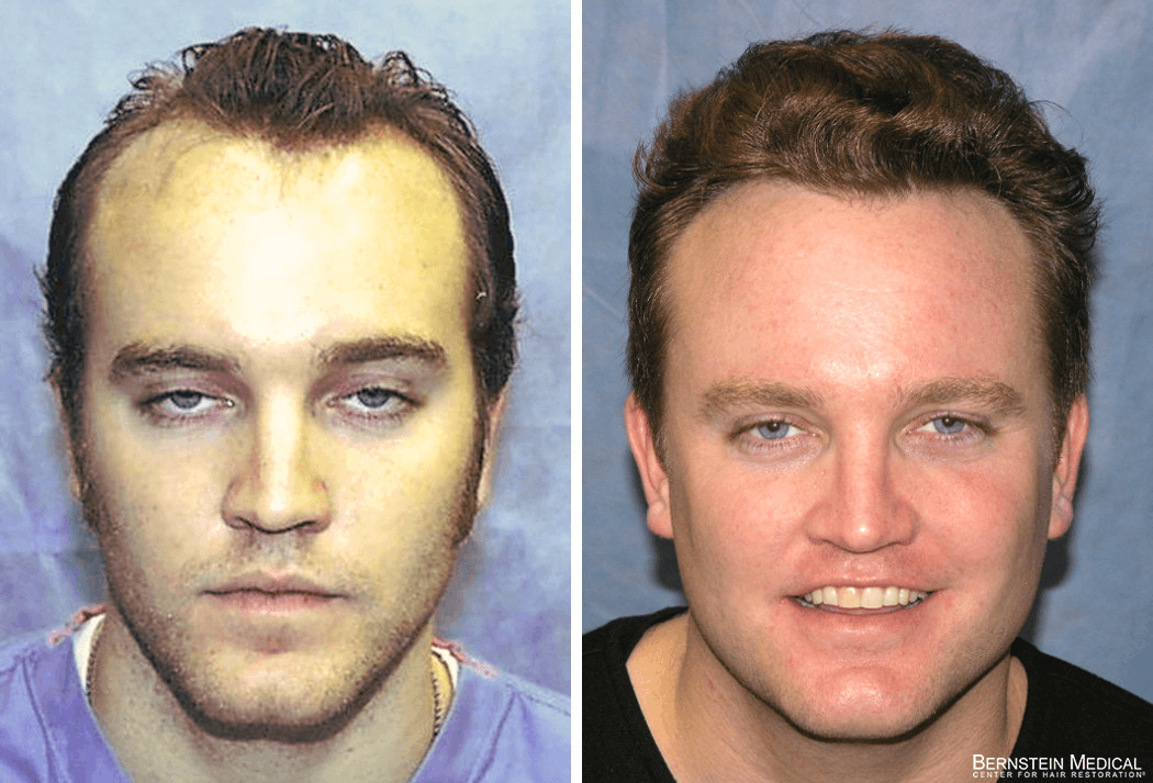 Bernstein Medical - Patient ONC Before and After Hair Transplant Photo 