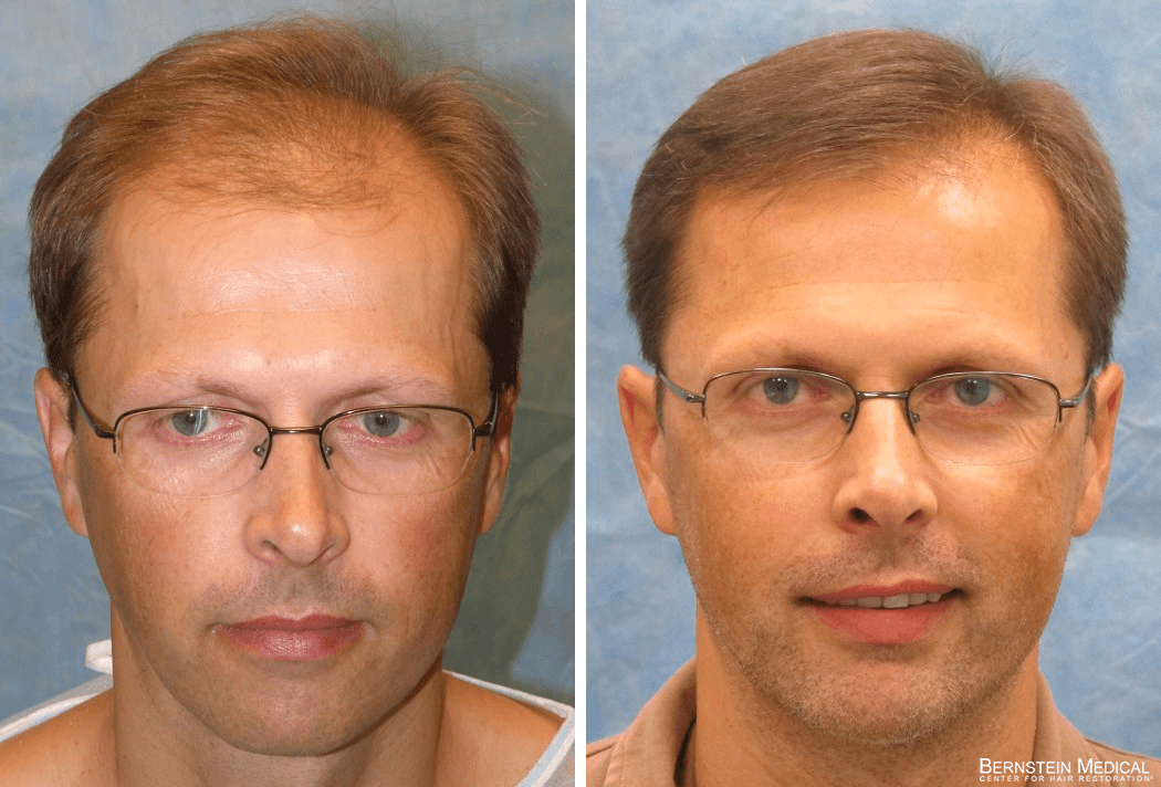 Bernstein Medical - Patient OXZ Before and After Hair Transplant Photo 