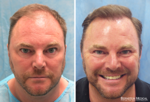 Before After Hair Transplant - Patient VXB