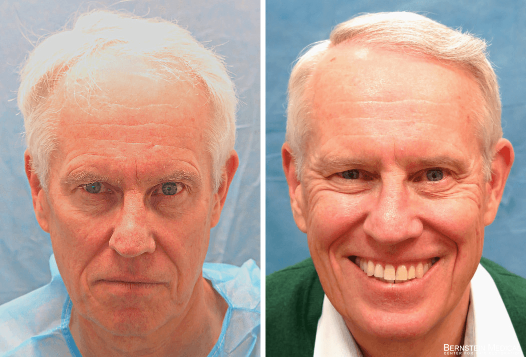 Bernstein Medical - Patient AYL Before and After Hair Transplant Photo 