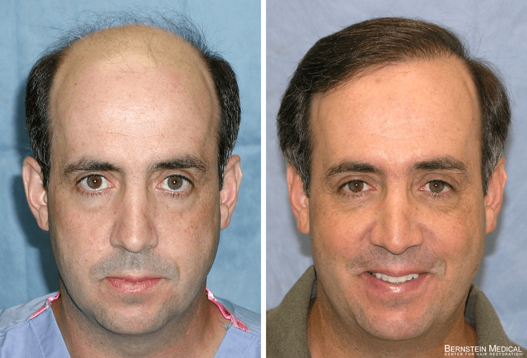 Bernstein Medical - Patient QPC Before and After Hair Transplant Photo 