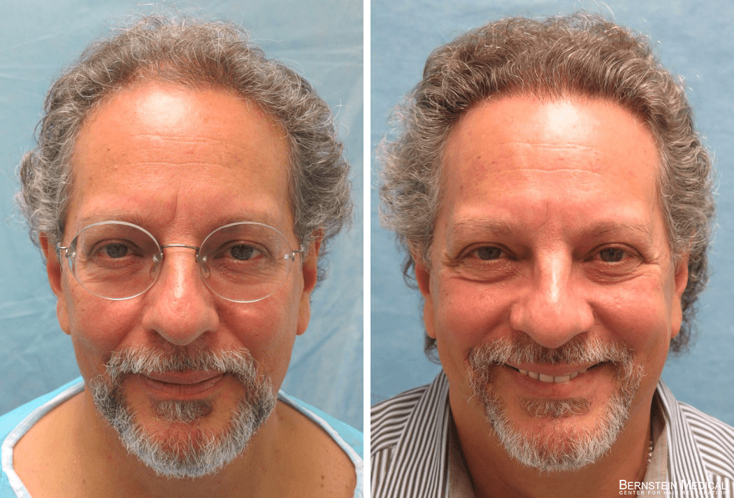 Bernstein Medical - Patient QWE Before and After Hair Transplant Photo 