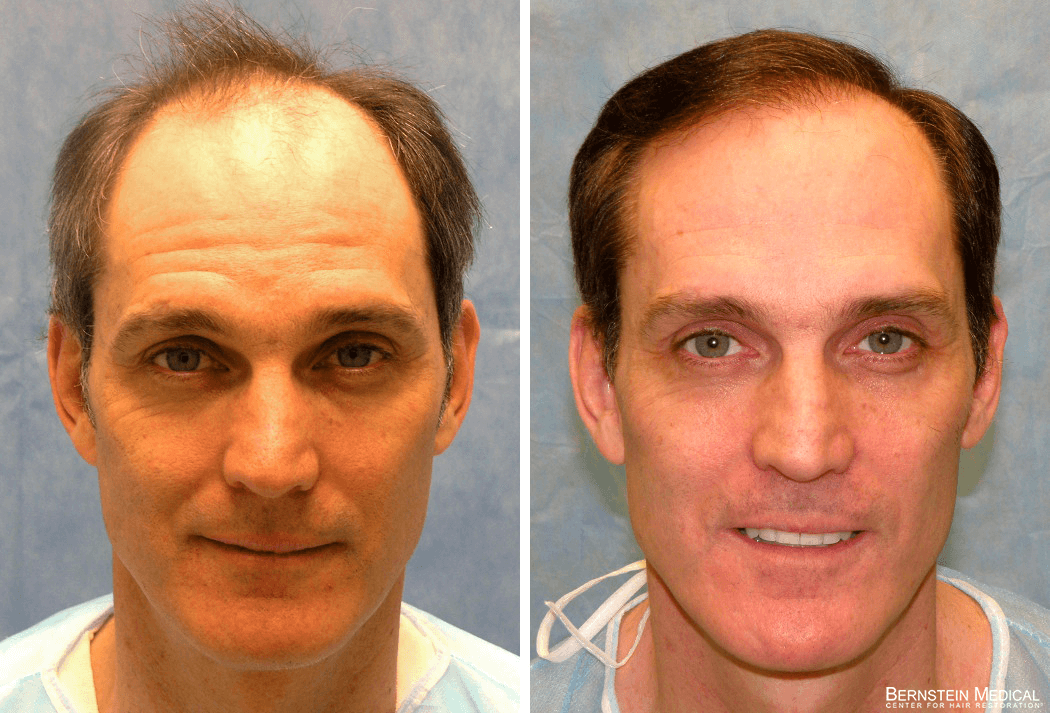 Bernstein Medical - Patient RAB Before and After Hair Transplant Photo 